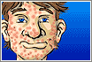 Acne be Gone