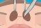 Operate Now: Nose Surgery