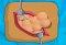 Operate Now: Appendix Surgery